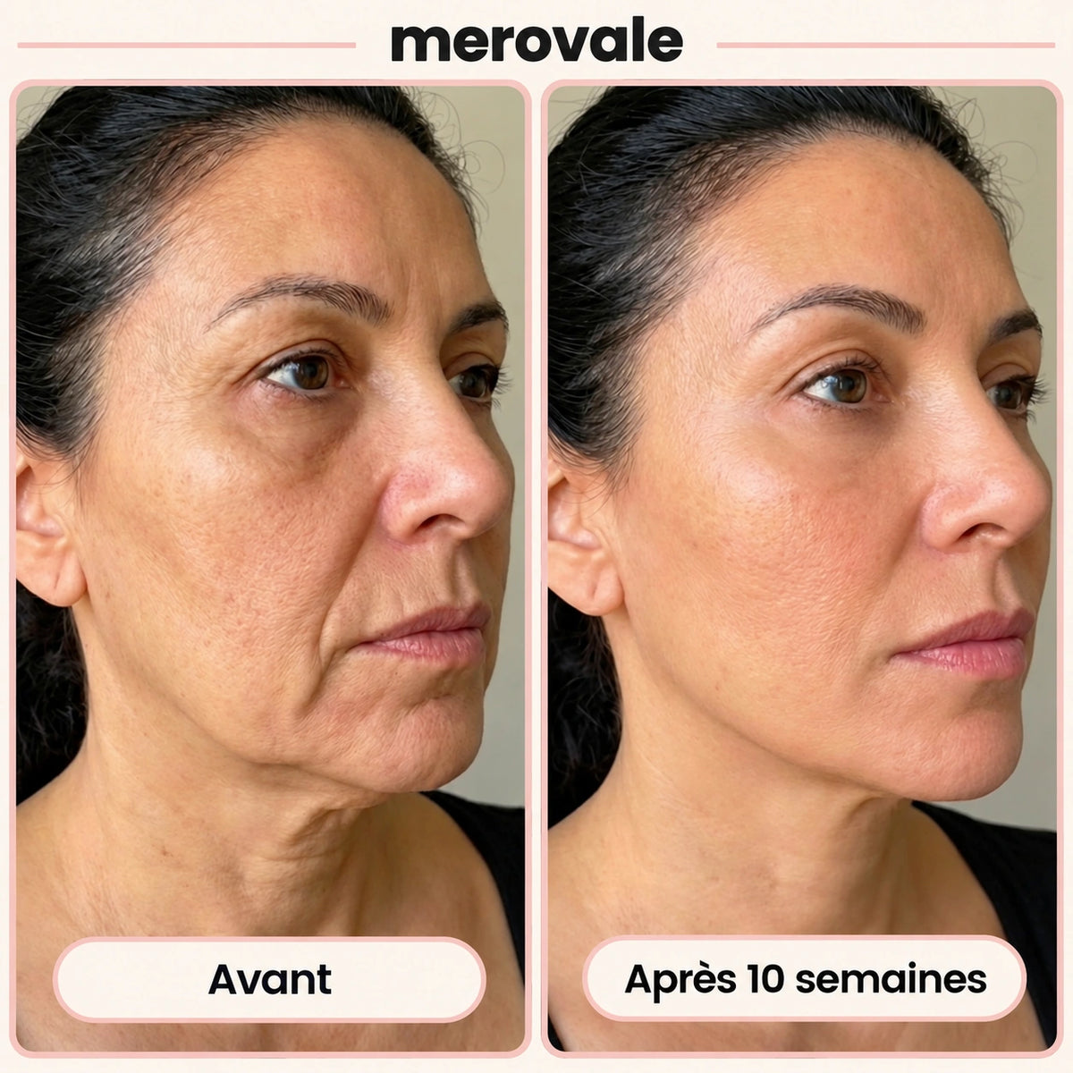Merovale — Avant / après · 10 semaines.