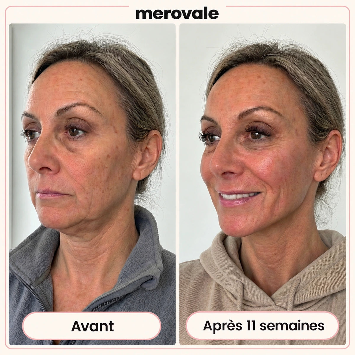Merovale — Avant / après · 11 semaines.