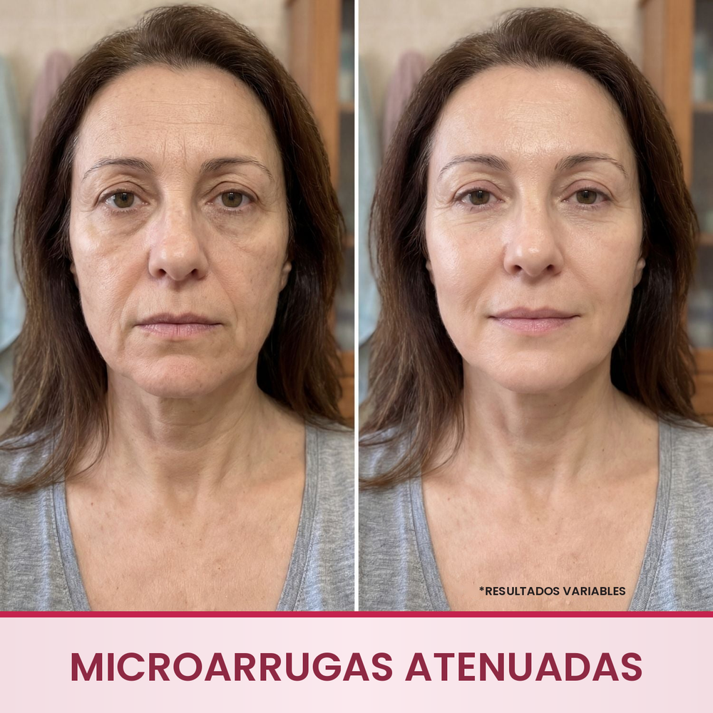 Sérum antiarrugas Merovale, resultados en arrugas profundas y arrugas de expresión menos visibles