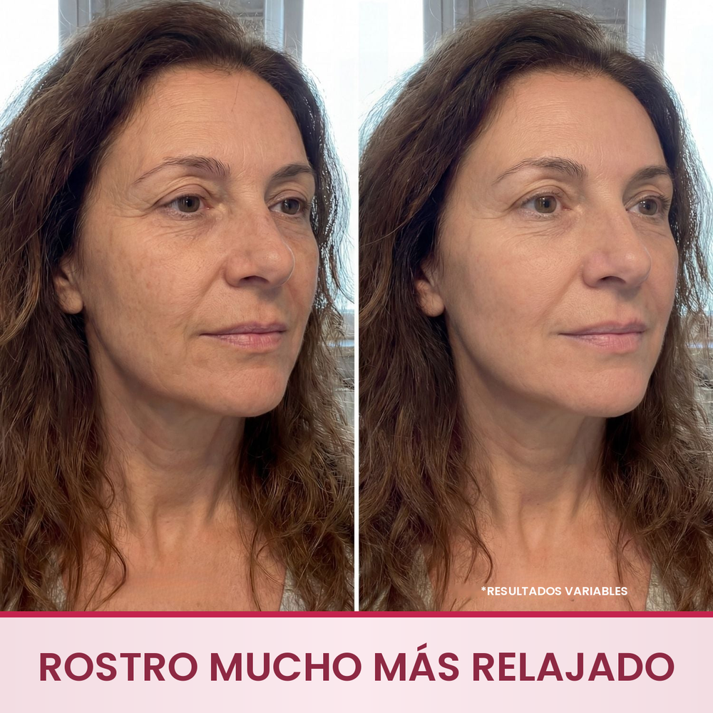 Sérum antiarrugas Merovale antes y después, rostro más relajado, arrugas de expresión reducidas y piel compacta